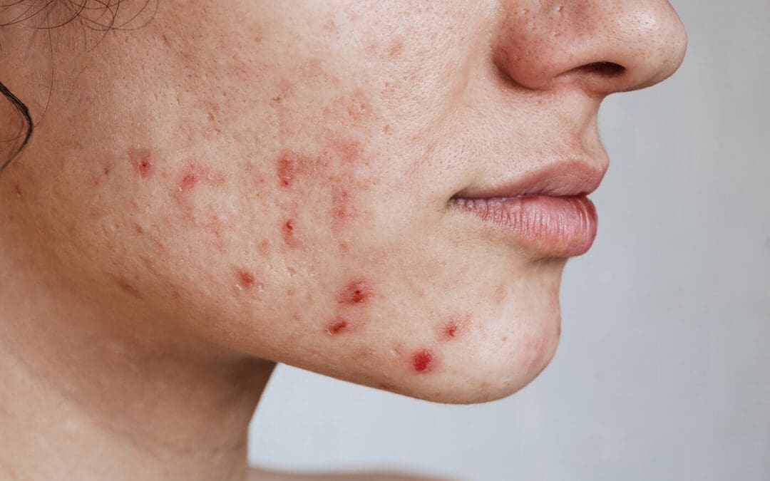 Akne: Diese Behandlungen könnten Abhilfe schaffen