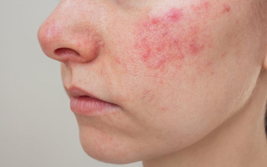 Rosazea – richtig behandeln