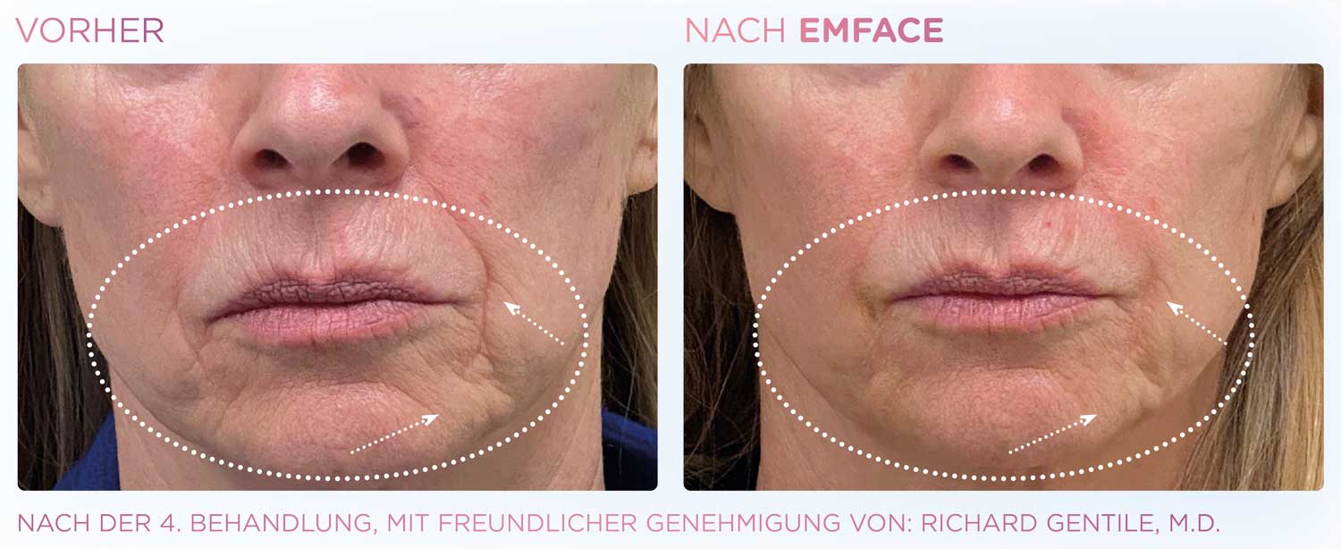 Nachher Bild