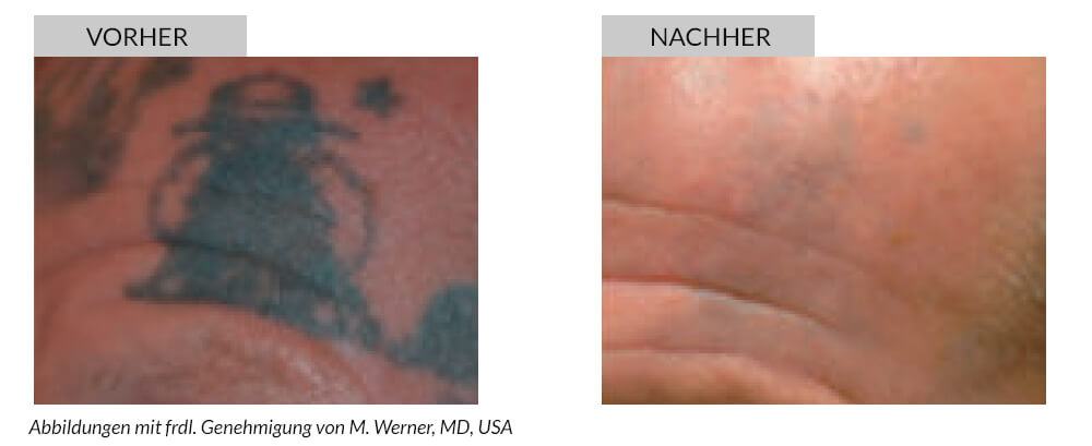 Tattooentfernung Vorher Nachher