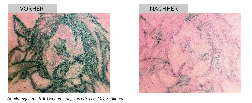 Tattooentfernung Vorher Nachher