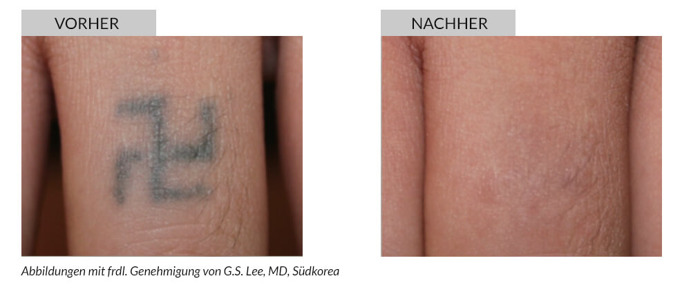 Tattooentfernung Vorher Nachher