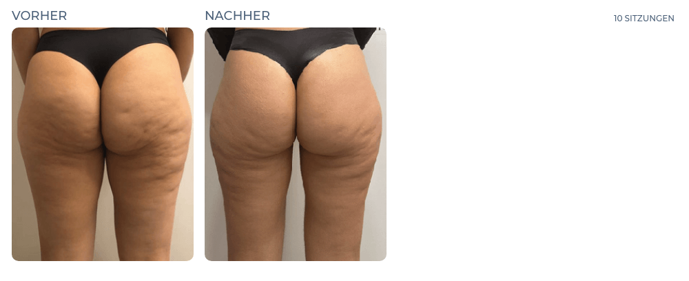 Cellution Vorher Nachher
