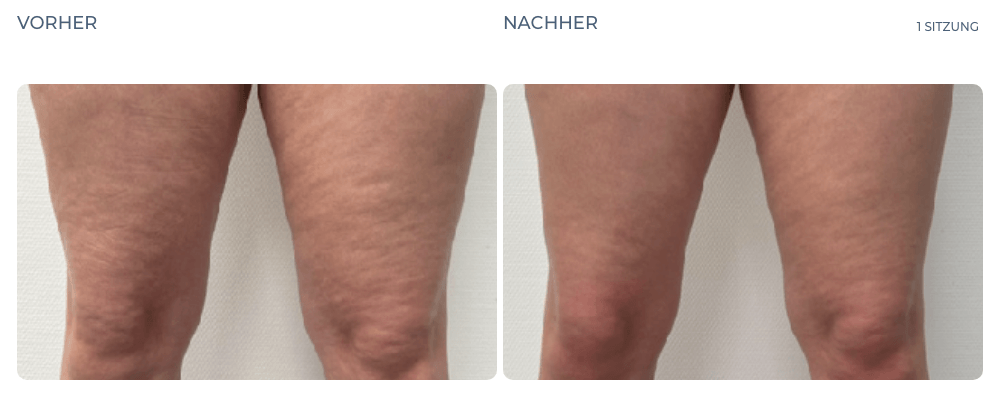 Cellution Vorher Nachher