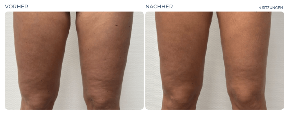 Cellution Vorher Nachher