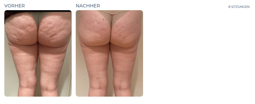Cellution Vorher Nachher