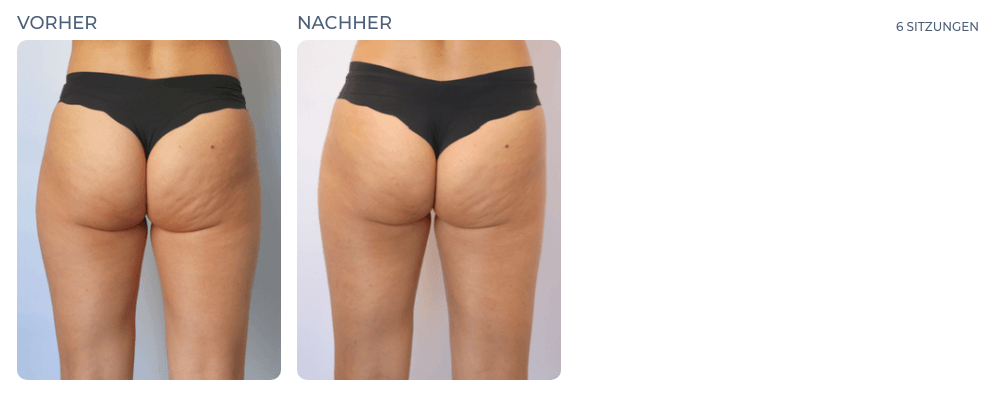 Cellution Vorher Nachher