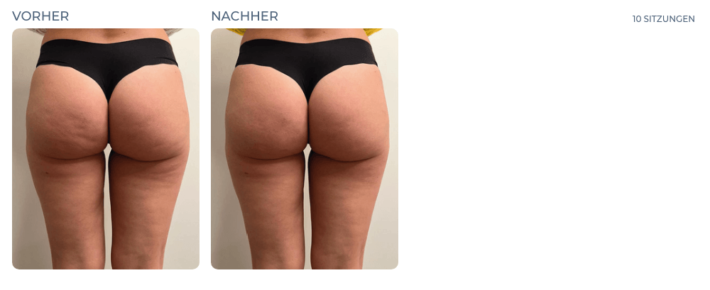 Cellution Vorher Nachher