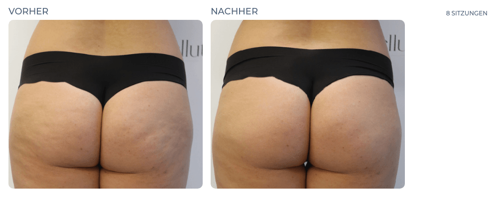 Cellution Vorher Nachher