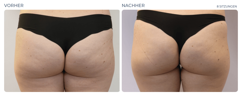 Cellution Vorher Nachher