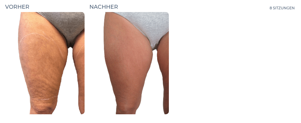 Cellution Vorher Nachher