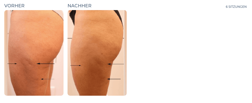 Cellution Vorher Nachher