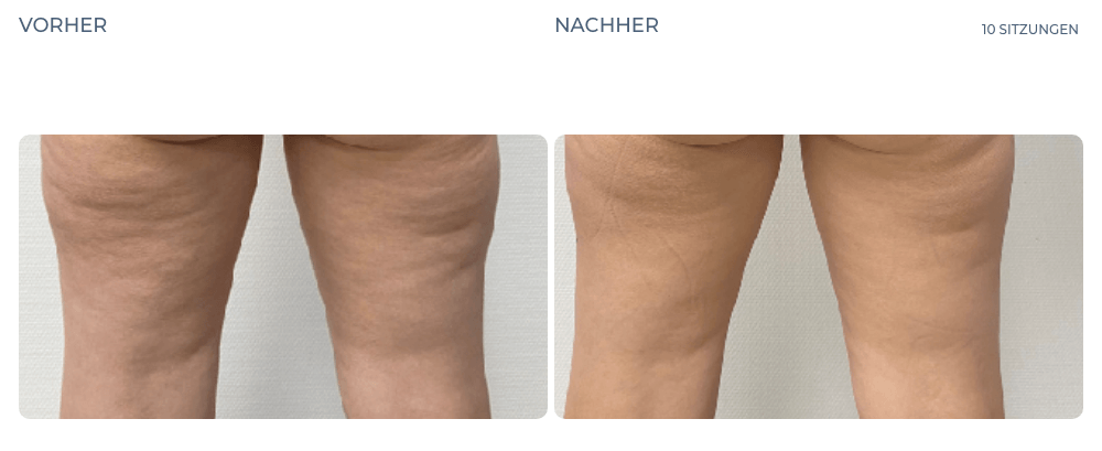 Cellution Vorher Nachher