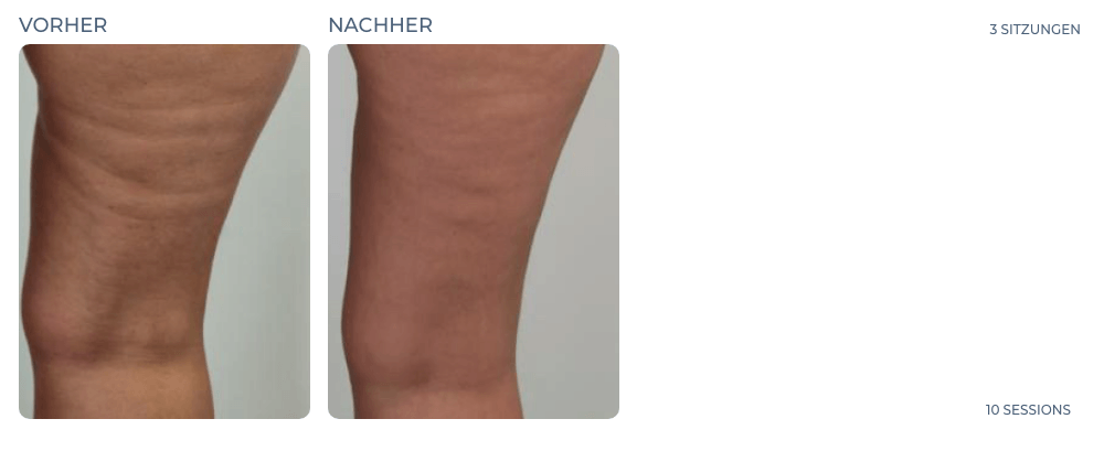 Cellution Vorher Nachher