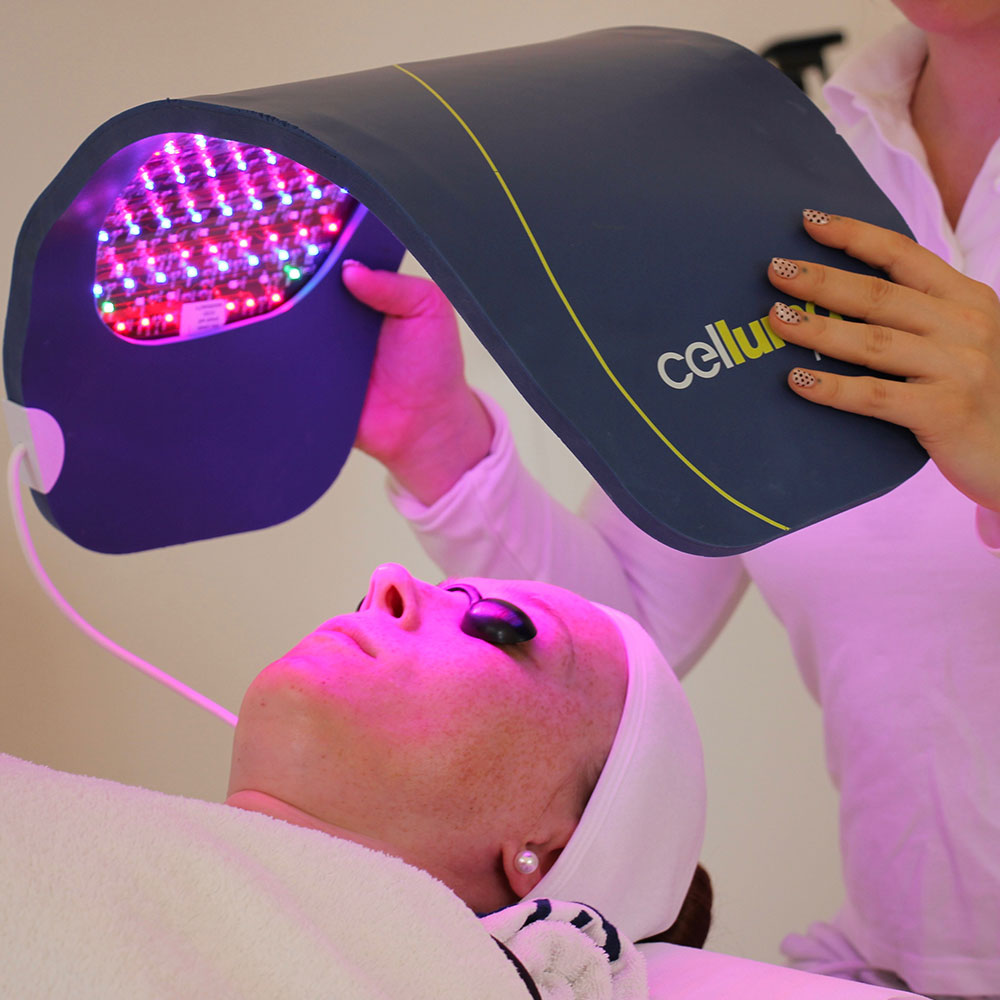 Wie funktioniert das Exosome Needling?